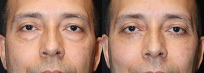 Lower Eyelid Surgery Before & After Gallery - Patient 413641 - Image 1