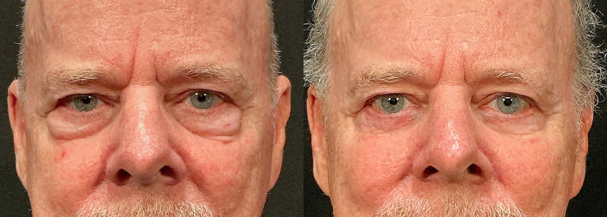 Lower Eyelid Surgery Before & After Gallery - Patient 197881 - Image 1