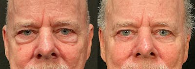 Lower Eyelid Surgery Before & After Gallery - Patient 197881 - Image 1
