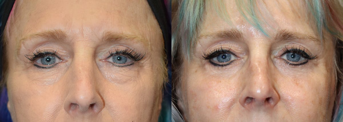 Lower Eyelid Surgery Before & After Gallery - Patient 275632 - Image 1