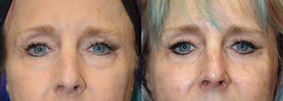 Lower Eyelid Surgery Before & After Gallery - Patient 275632 - Image 1