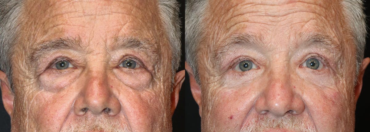 Lower Eyelid Surgery Before & After Gallery - Patient 426194 - Image 1