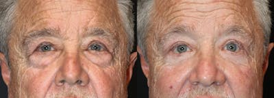 Lower Eyelid Surgery Before & After Gallery - Patient 426194 - Image 1