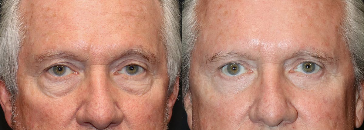 Lower Eyelid Surgery Before & After Gallery - Patient 384873 - Image 1