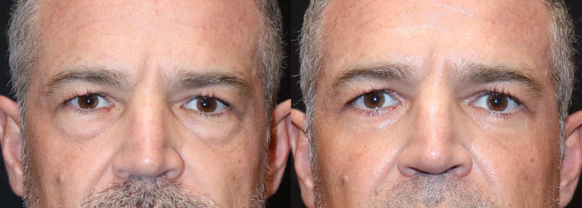 Lower Eyelid Surgery Before & After Gallery - Patient 295834 - Image 1