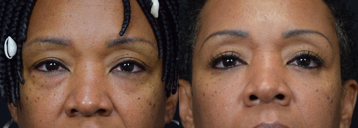 Lower Eyelid Surgery Before & After Gallery - Patient 261726 - Image 1
