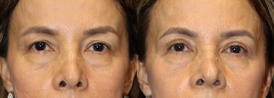 Upper Eyelid Surgery Before & After Gallery - Patient 118140 - Image 1