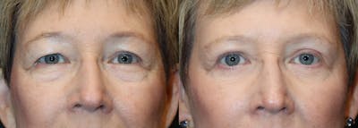 Upper Eyelid Surgery Before & After Gallery - Patient 330427 - Image 1