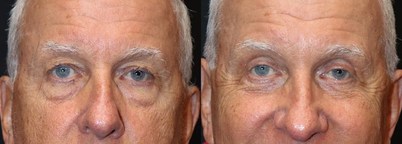 Upper Eyelid Surgery Before & After Gallery - Patient 164762 - Image 1