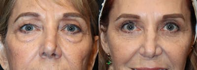 Upper Eyelid Surgery Before & After Gallery - Patient 298732 - Image 1