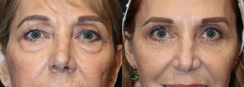 Upper Eyelid Surgery Before & After Gallery - Patient 298732 - Image 1