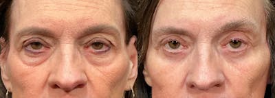 Upper Eyelid Surgery Before & After Gallery - Patient 263556 - Image 1