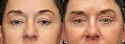 Upper Eyelid Surgery Before & After Gallery - Patient 125843 - Image 1