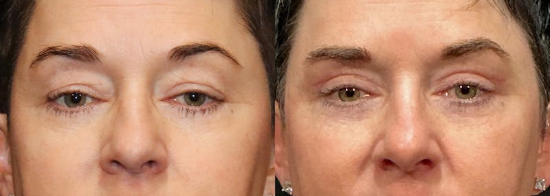 Upper Eyelid Surgery Before & After Gallery - Patient 125843 - Image 1