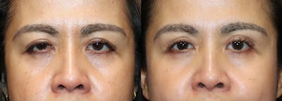 Upper Eyelid Surgery Before & After Gallery - Patient 129408 - Image 1