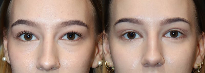 Upper Eyelid Surgery Before & After Gallery - Patient 975873 - Image 1