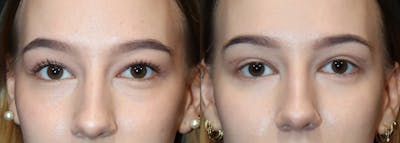 Upper Eyelid Surgery Before & After Gallery - Patient 975873 - Image 1