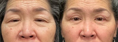 Upper Eyelid Surgery Before & After Gallery - Patient 380091 - Image 1