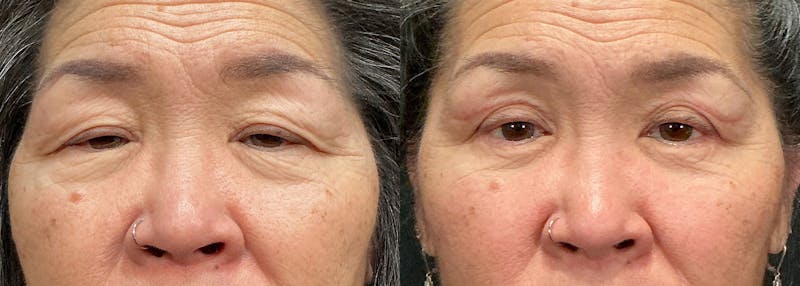 Upper Eyelid Surgery Before & After Gallery - Patient 380091 - Image 1