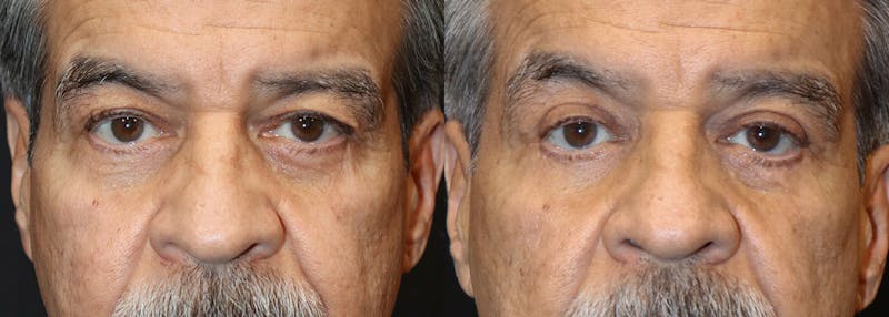 Upper Eyelid Surgery Before & After Gallery - Patient 283504 - Image 1