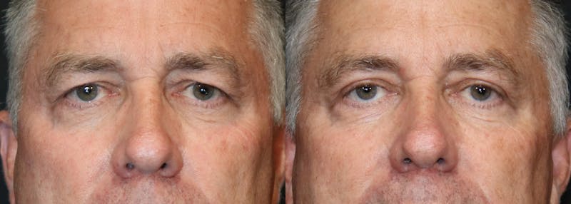 Upper Eyelid Surgery Before & After Gallery - Patient 364864 - Image 1