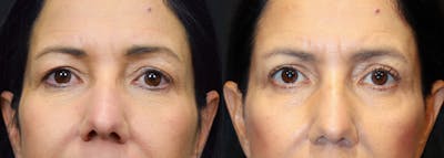 Upper Eyelid Surgery Before & After Gallery - Patient 623520 - Image 1