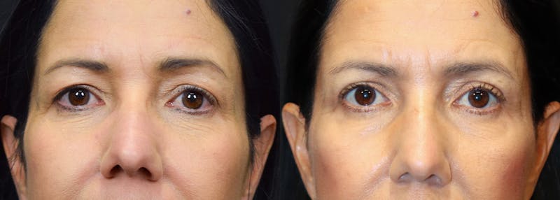 Upper Eyelid Surgery Before & After Gallery - Patient 623520 - Image 1