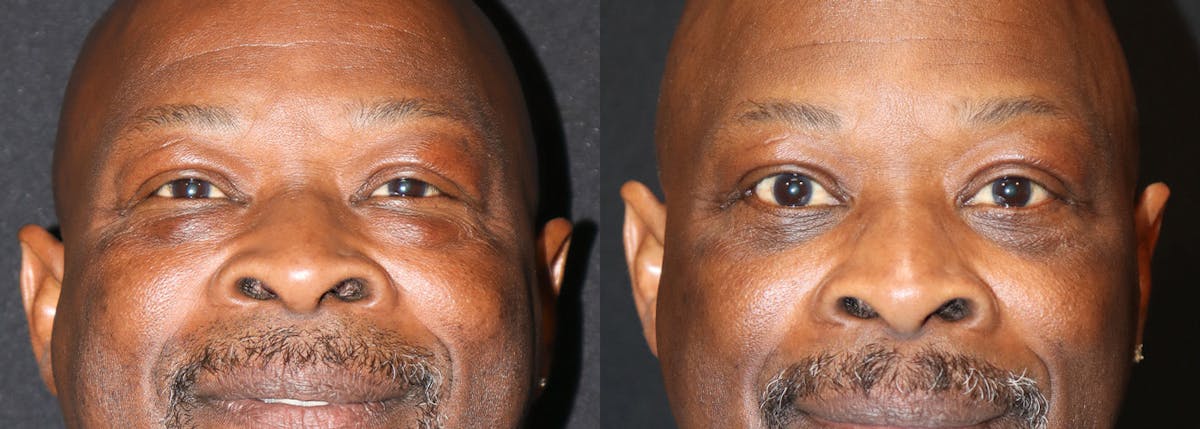 Lower Eyelid Surgery Before & After Gallery - Patient 274540 - Image 1