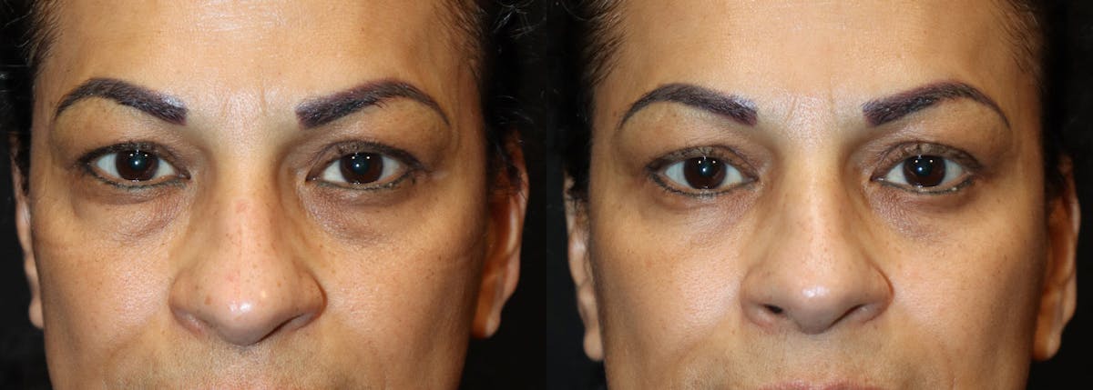 Lower Eyelid Surgery Before & After Gallery - Patient 254413 - Image 1