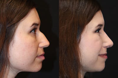 Rhinoplasty Before & After Gallery - Patient 584345 - Image 1