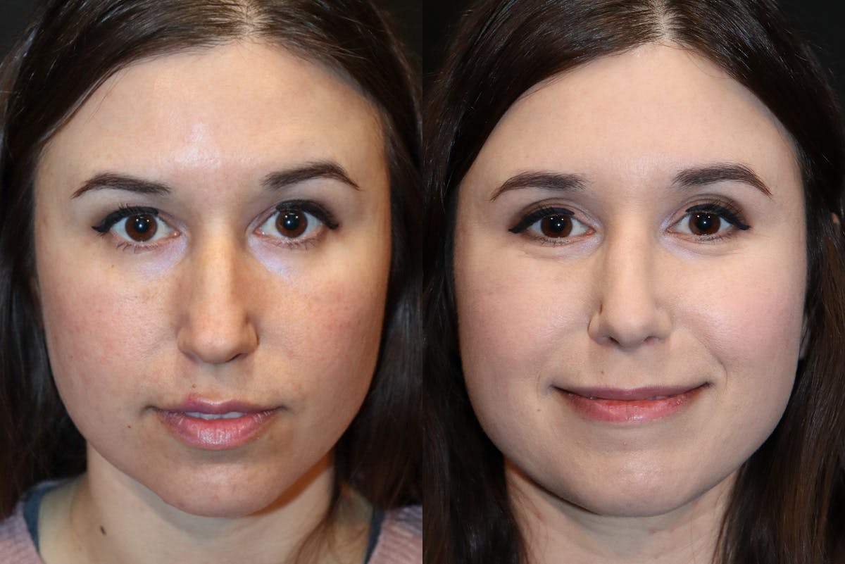 Rhinoplasty Before & After Gallery - Patient 584345 - Image 2