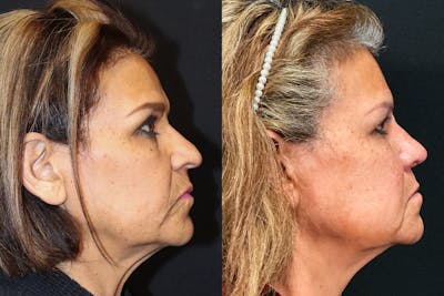Rhinoplasty Before & After Gallery - Patient 501264 - Image 1