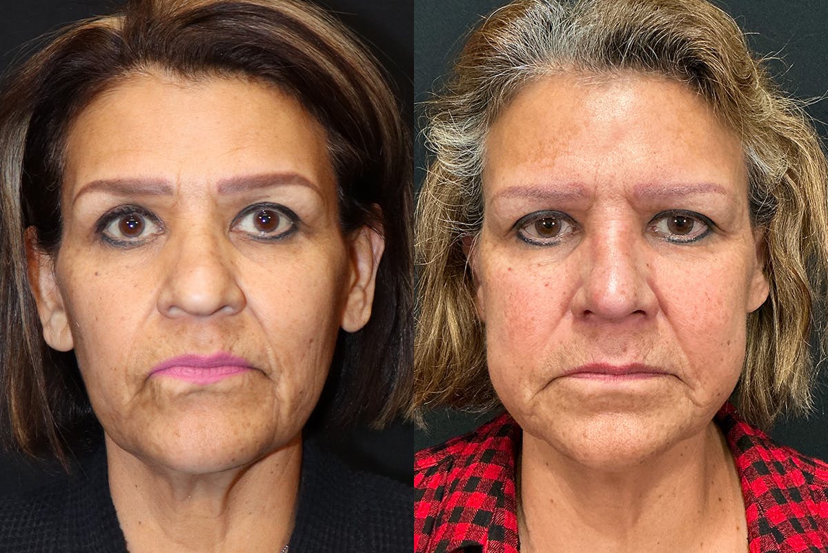 Rhinoplasty Before & After Gallery - Patient 501264 - Image 2