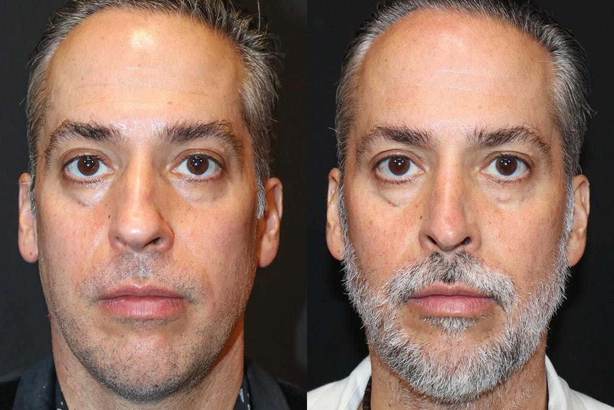 Rhinoplasty Before & After Gallery - Patient 146936 - Image 2