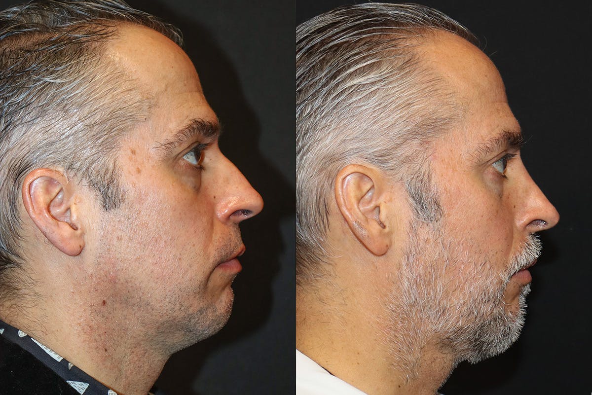 Rhinoplasty Before & After Gallery - Patient 146936 - Image 1