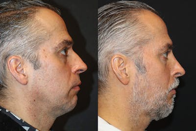Rhinoplasty Before & After Gallery - Patient 146936 - Image 1