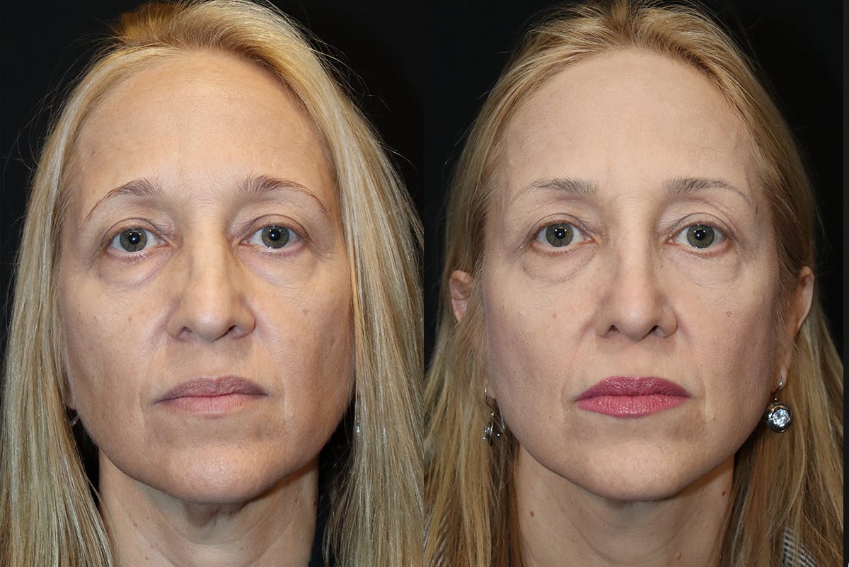 Rhinoplasty Before & After Gallery - Patient 843646 - Image 2
