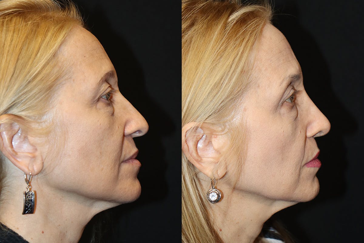 Rhinoplasty Before & After Gallery - Patient 843646 - Image 1
