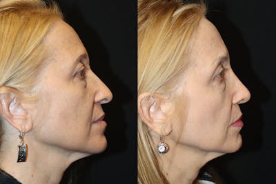 Rhinoplasty Before & After Gallery - Patient 843646 - Image 1
