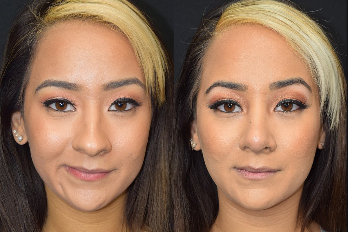 Rhinoplasty Before & After Gallery - Patient 383064 - Image 2