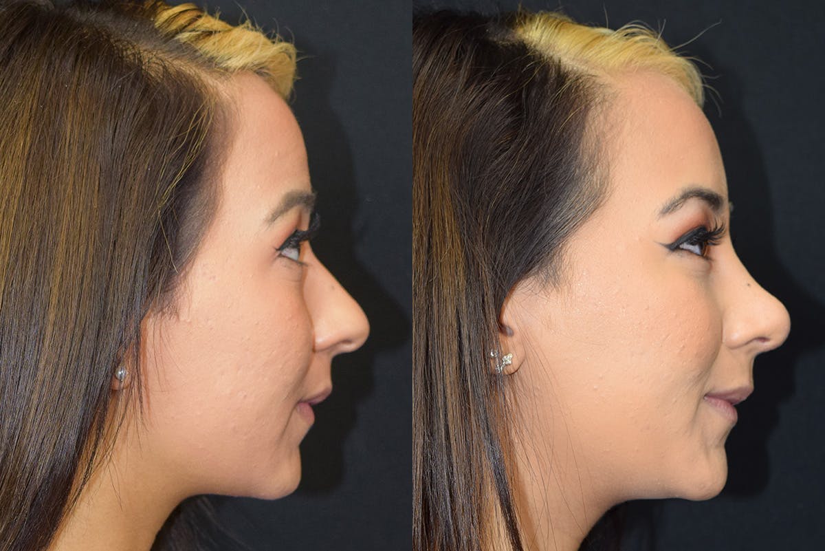 Rhinoplasty Before & After Gallery - Patient 383064 - Image 1