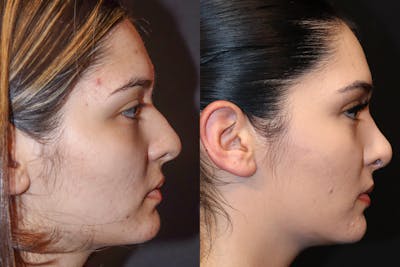 Rhinoplasty Before & After Gallery - Patient 385184 - Image 1