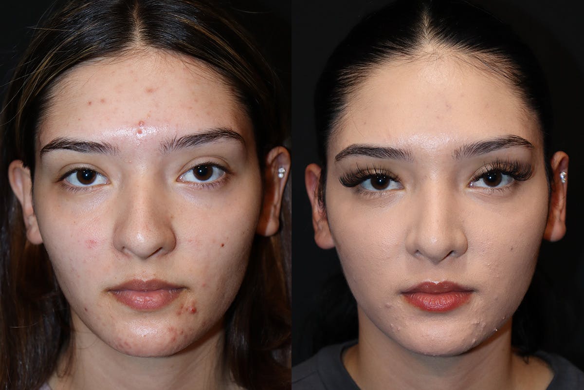 Rhinoplasty Before & After Gallery - Patient 385184 - Image 2