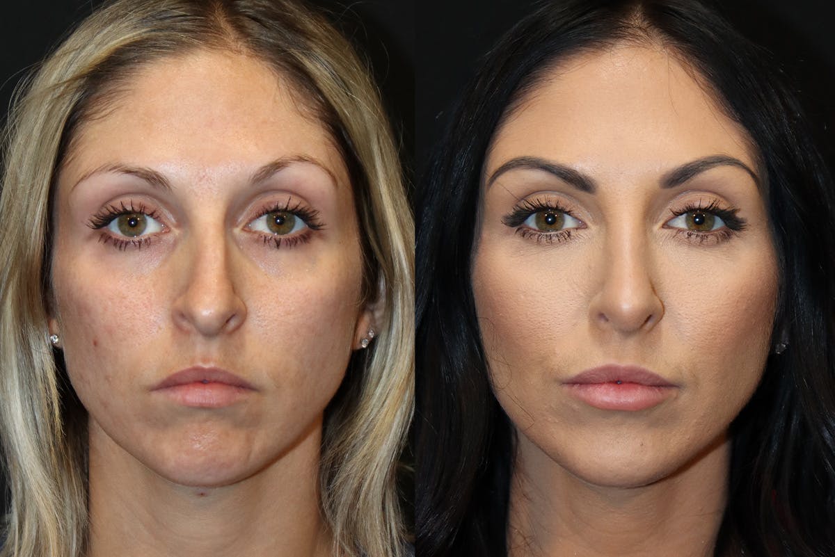 Rhinoplasty Before & After Gallery - Patient 395920 - Image 2