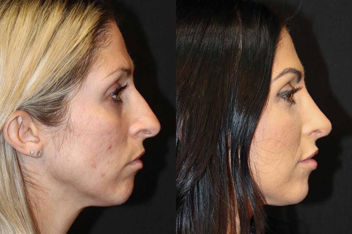 Rhinoplasty Before & After Gallery - Patient 395920 - Image 1