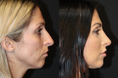 Rhinoplasty Before & After Gallery - Patient 395920 - Image 1