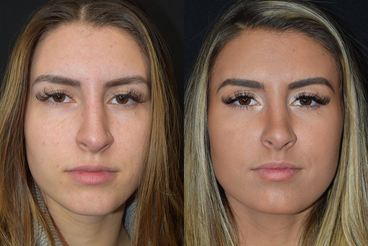 Rhinoplasty Before & After Gallery - Patient 281292 - Image 2