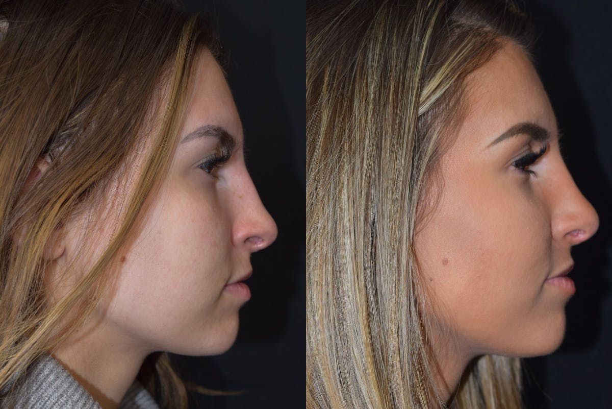 Rhinoplasty Before & After Gallery - Patient 281292 - Image 1