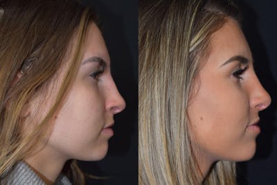 Rhinoplasty Before & After Gallery - Patient 281292 - Image 1
