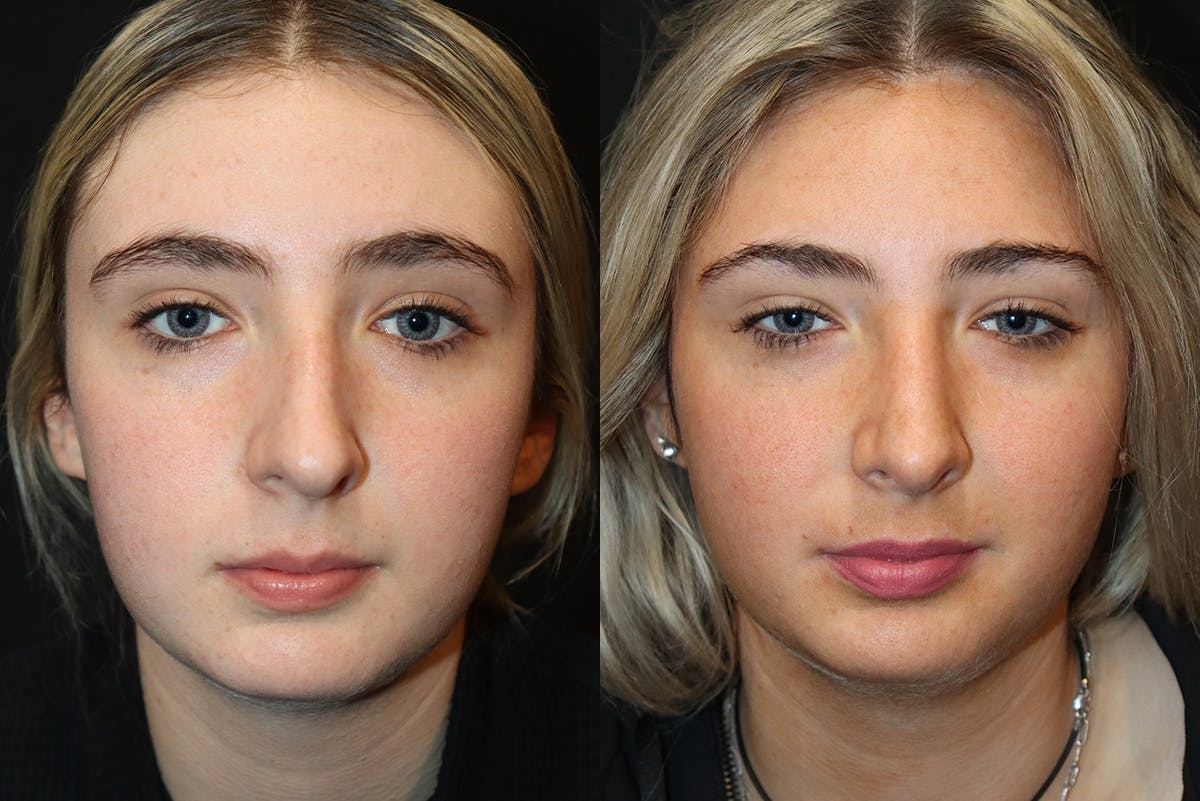 Rhinoplasty Before & After Gallery - Patient 136275 - Image 2
